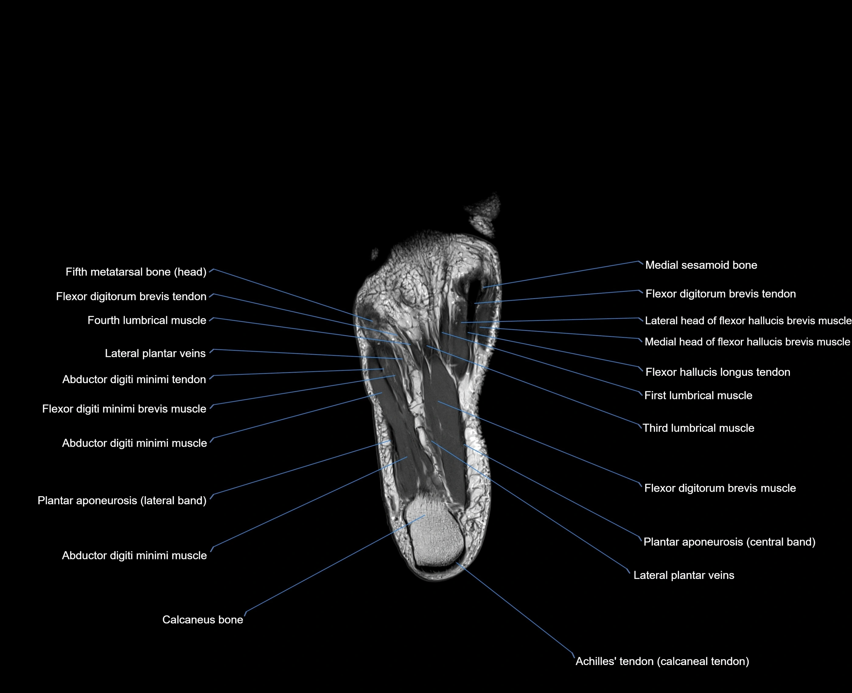 MRI foot coronal cross sectional anatomy 3T  radiology  image-img-00001-00028.webp